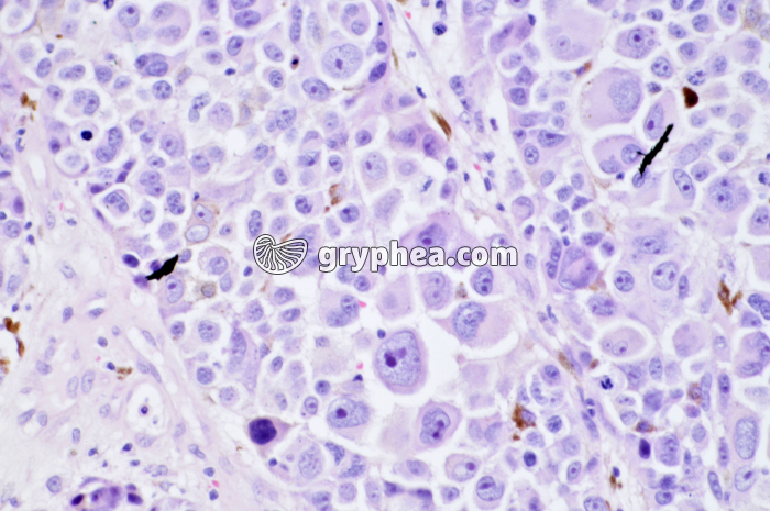 Cancer de la peau x100 - gryphea.org